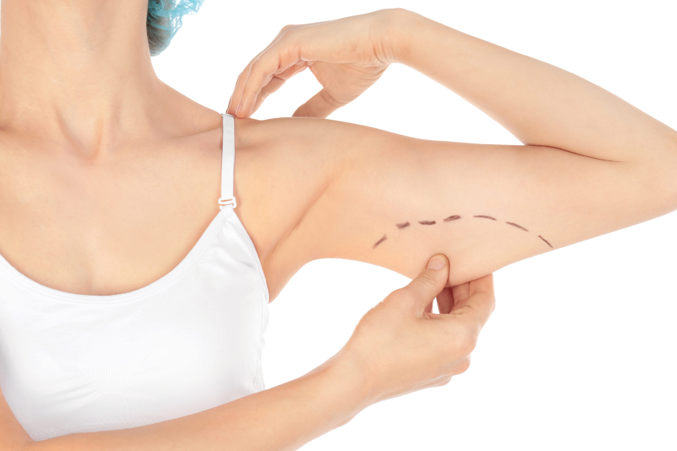 Woman with marks on arm for cosmetic surgery operation against white background, closeup